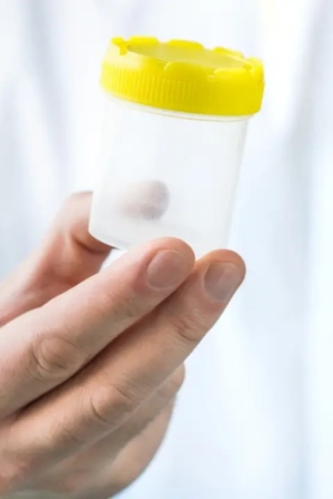 detectan-el-primer-caso-de-transmision-de-una-enfermedad-rara-mediante-donante-de-esperma-57980